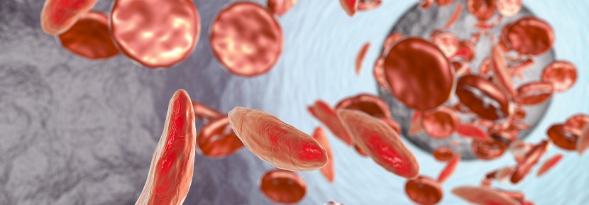 Novel Gene Therapy Technique Creates a Breakthrough in Sickle Cell Anemia Treatment